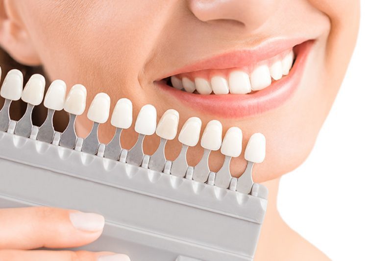 Bọc răng sứ là gì? Tác dụng của bọc răng sứ
