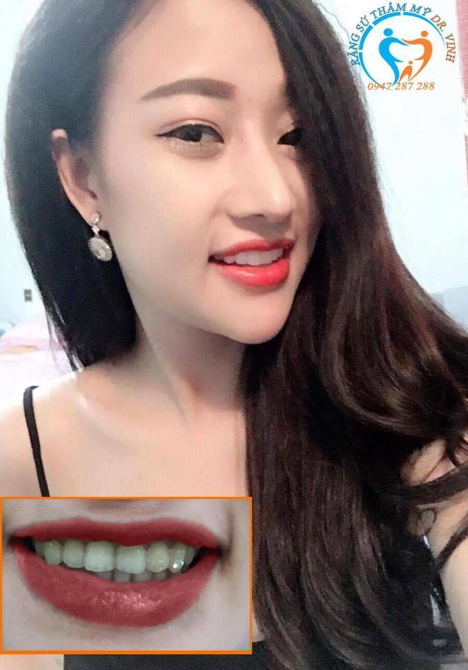 Niềng Răng Hà Nội