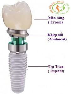 Cau-tao-rang-implant-1