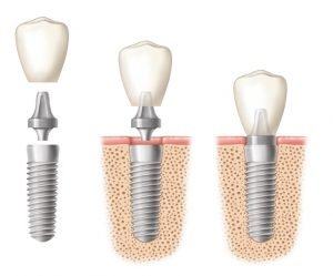 Chi phí cấy ghép implant thấp hơn khi bọn làm cầu răng sứ cao cấp