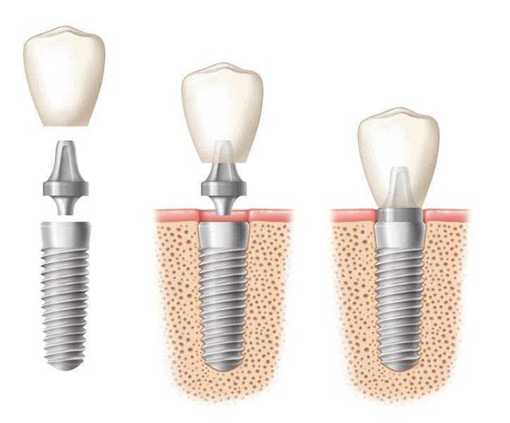 Nha-khoa-implant-3