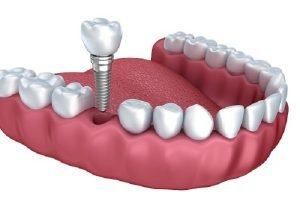 Cay ghep implant