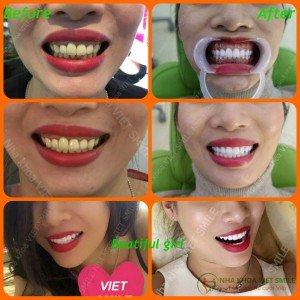Niềng Răng Hà Nội
