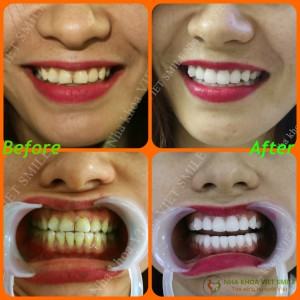 Niềng Răng Hà Nội