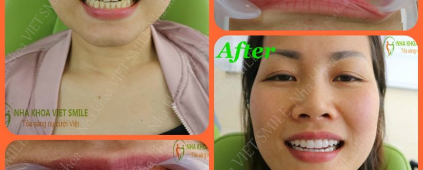 Niềng Răng Hà Nội