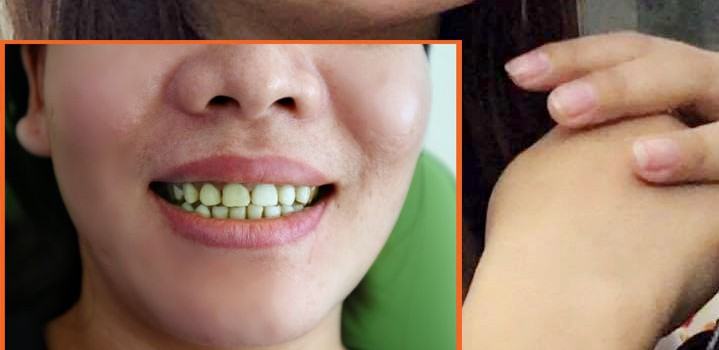 Niềng Răng Hà Nội