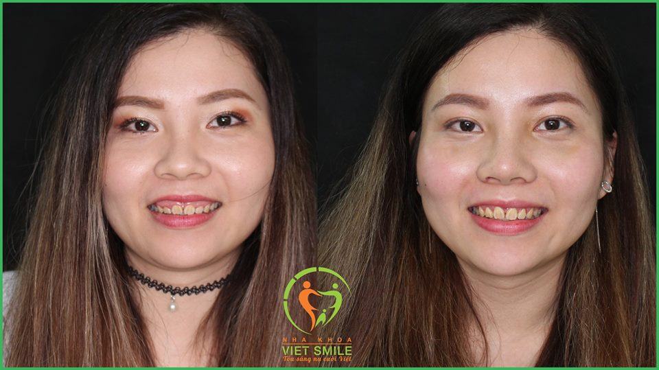 Niềng Răng Hà Nội