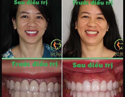 Niềng Răng Hà Nội
