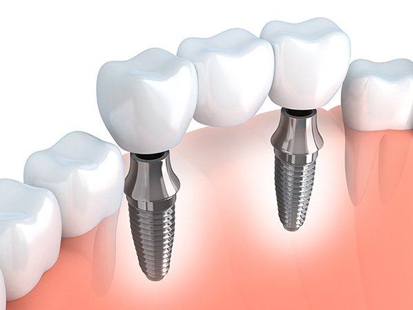 Trụ răng implant kết hợp cầu răng khi mất 3 răng liên tiếp