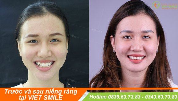 Niềng răng có đau kinh khủng như bạn tưởng 1 Vietsmile nieng rang an toan 1574243802
