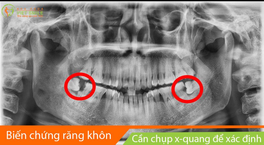 Chụp x-quang răng khôn