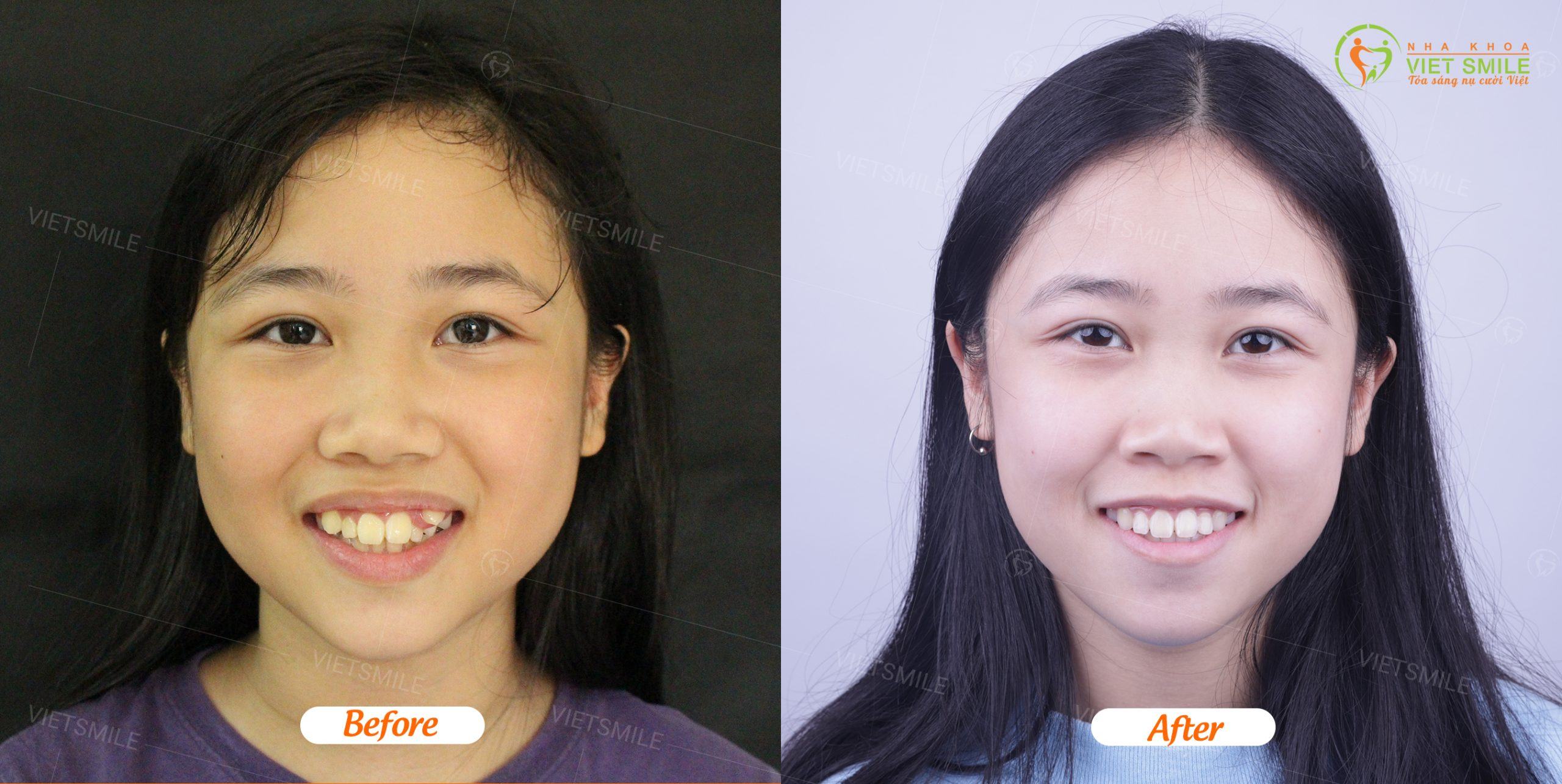 Trước và sau khi niềng răng tại nha khoa việt smile