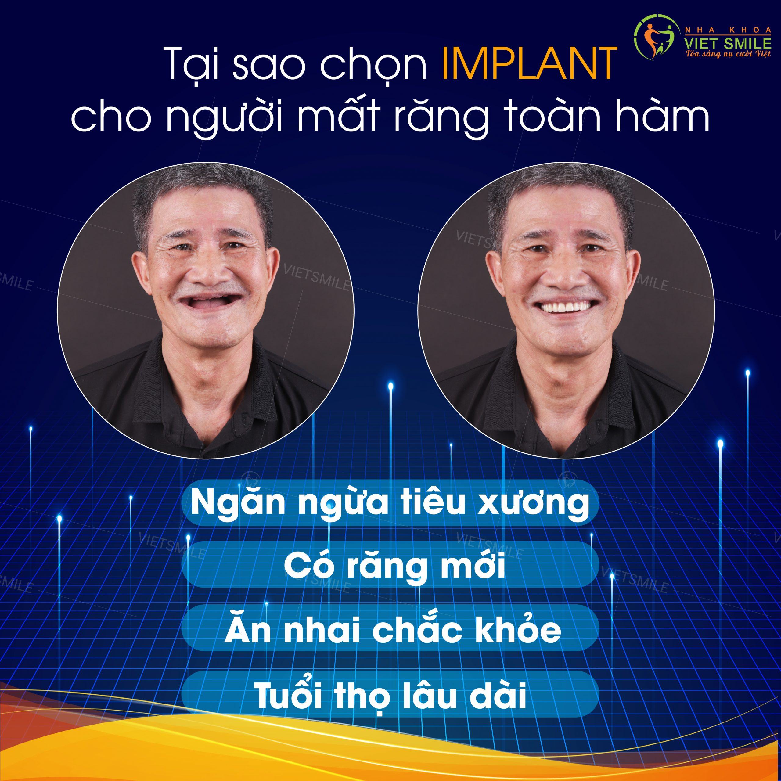 hiệu quả của cấy ghép implant phụ thuộc vào những yếu tố nào? 2 Cấy ghép implant