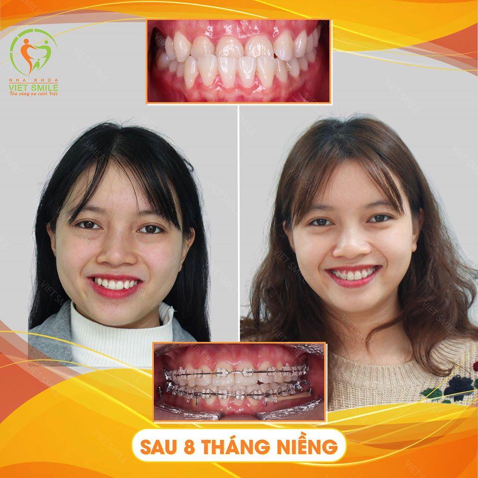 Niềng Răng Hà Nội