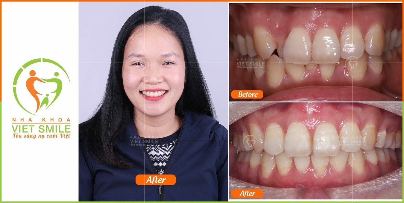 band niềng răng là gì? gắn band niềng răng có đau không? 4 Ket qua nieng rang