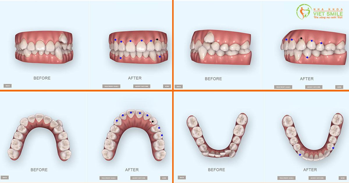 Kết quả niềng răng trước và sau được phân tích và tái lập với công nghệ scan 3d