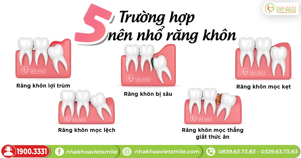 Các trường hợp được nha sĩ chỉ định nhổ răng số 8