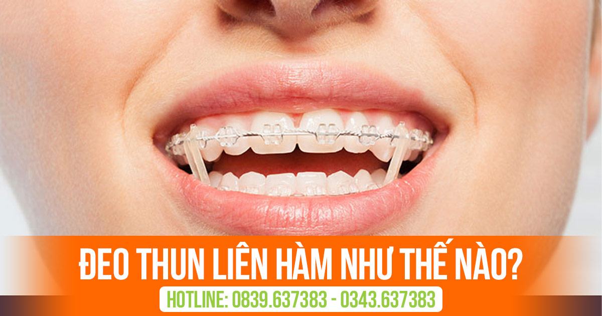 Đeo thun liên hàm như thế nào? 1 Deo thun lien ham nhu the nao