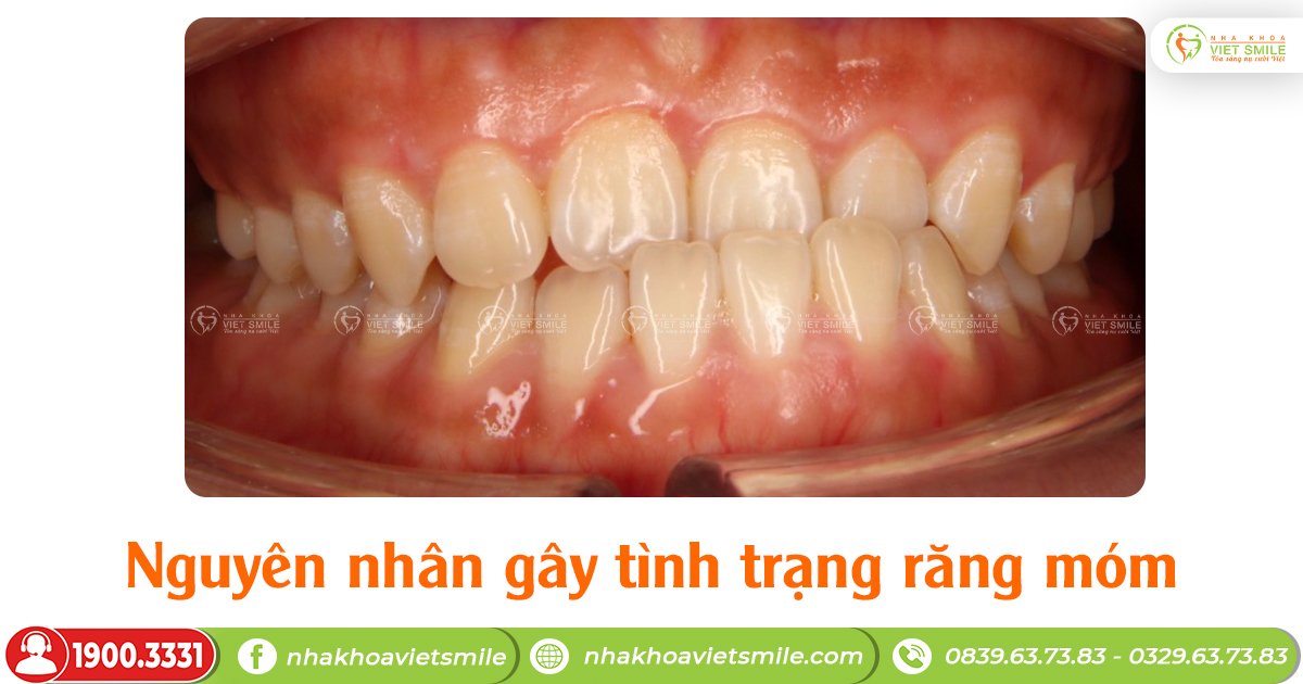 Nguyên nhân gây tình trạng răng móm