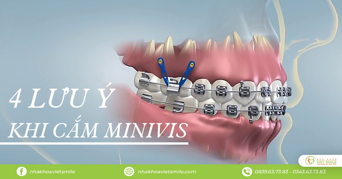 Minivis niềng răng