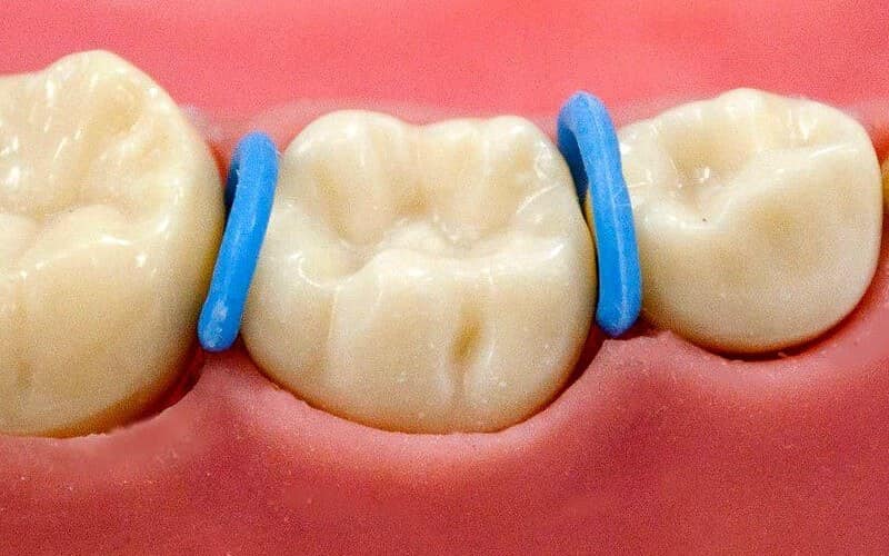 mách bạn 6 điều khi đặt thun tách kẽ niềng răng 1 Vietsmile dat thun tach ke nieng rang