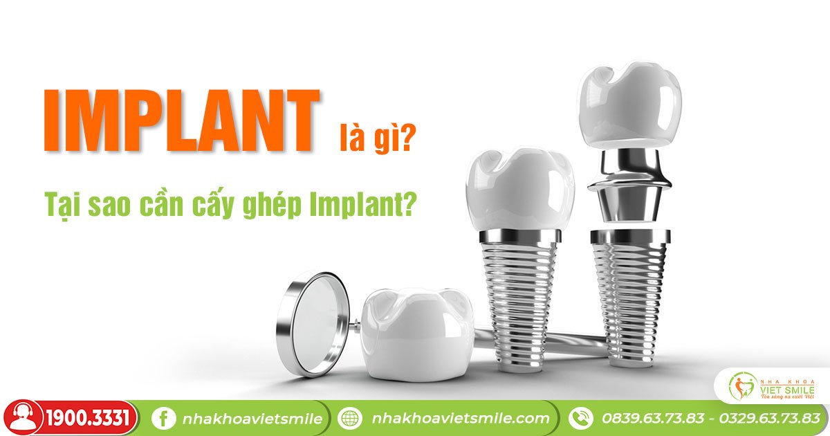 Implant là gì?