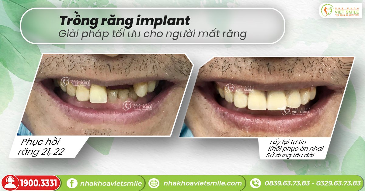 Thời gian cấy ghép implant bao lâu?