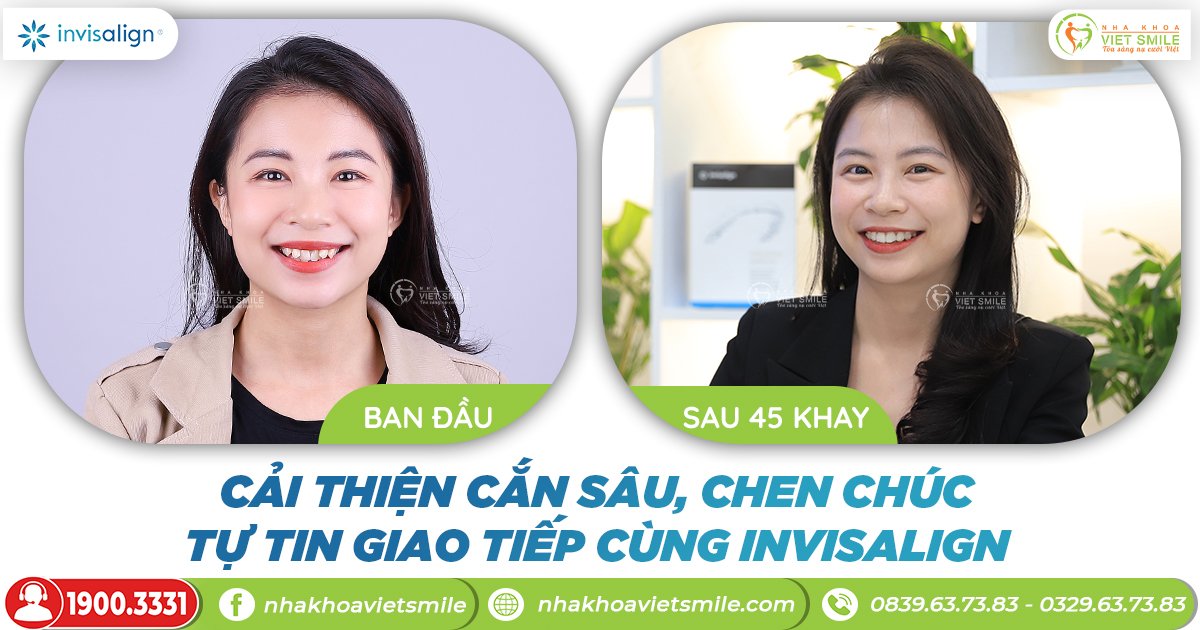 Invisalign niềng trong suốt