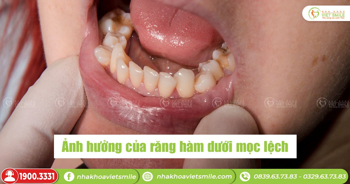 Ảnh hưởng của răng hàm dưới bị lệch