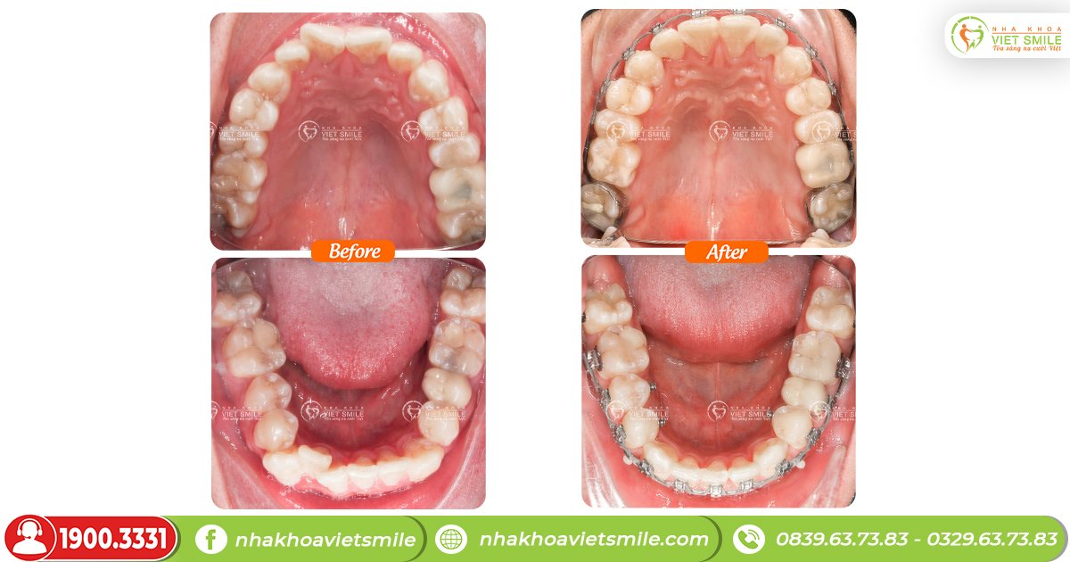 Niềng răng giúp răng hàm mọc lệch về đúng khớp cắn, ăn nhai tốt hơn, vệ sinh dễ dàng hơn