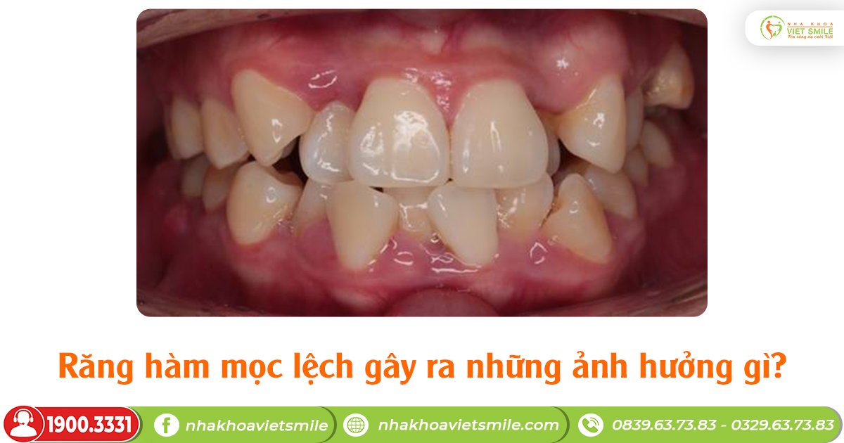Răng hàm mọc lệch gây ra những ảnh hưởng gì?