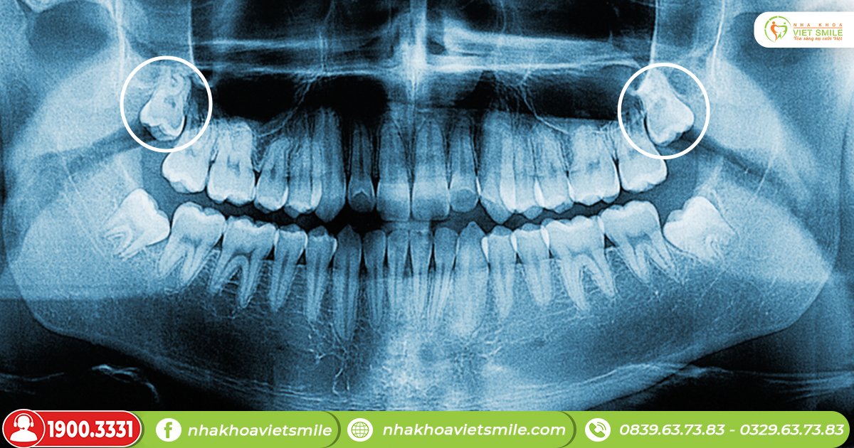 Răng khôn là gì? Răng khôn mọc lệch nhưng không đau có nên nhổ?