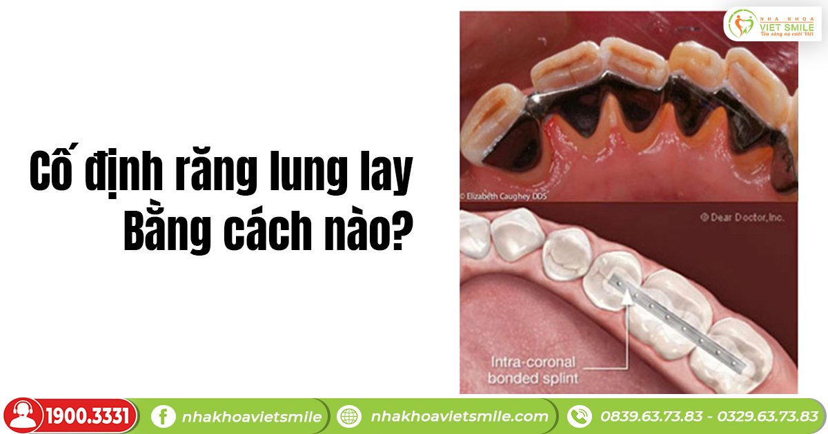 Cố định răng lung lay bằng cách nào?