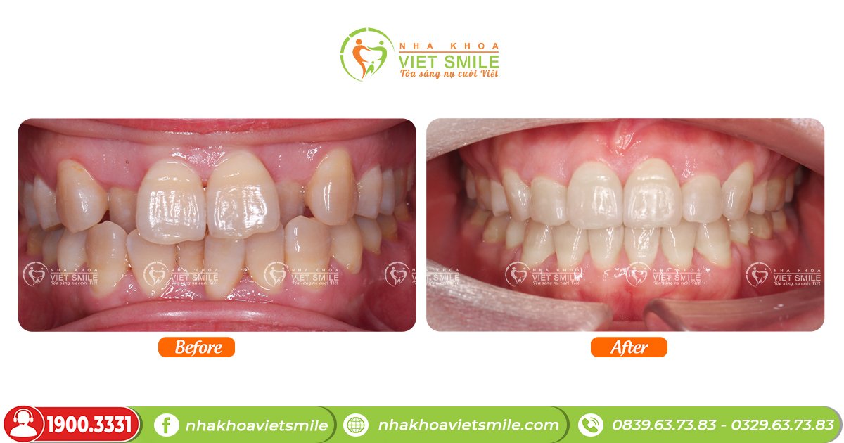 Hàm răng chuẩn giúp bạn hạn chế bệnh về răng miệng
