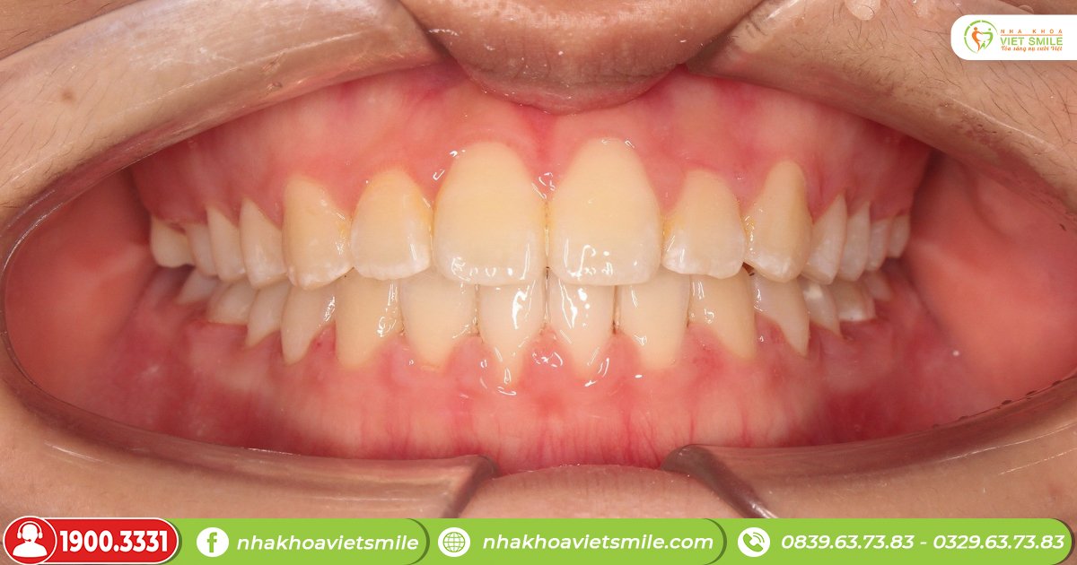 Khớp cắn chuẩn giúp tránh được các bệnh lí về răng miệng