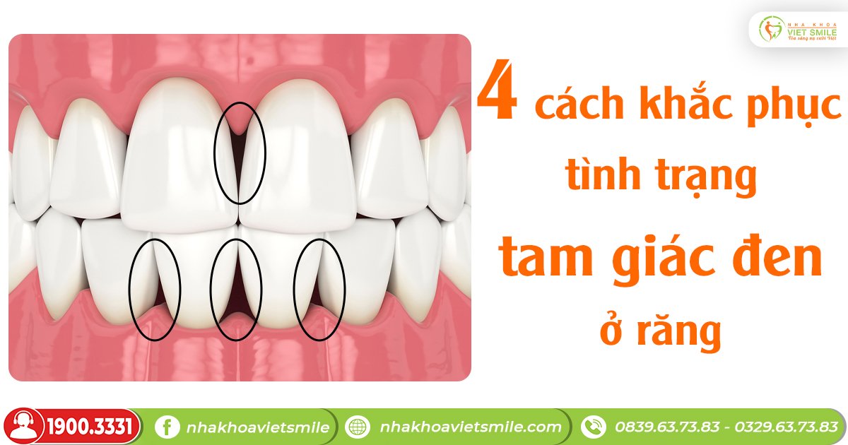 4 cách khắc phục tình trạng tam giác đen ở răng