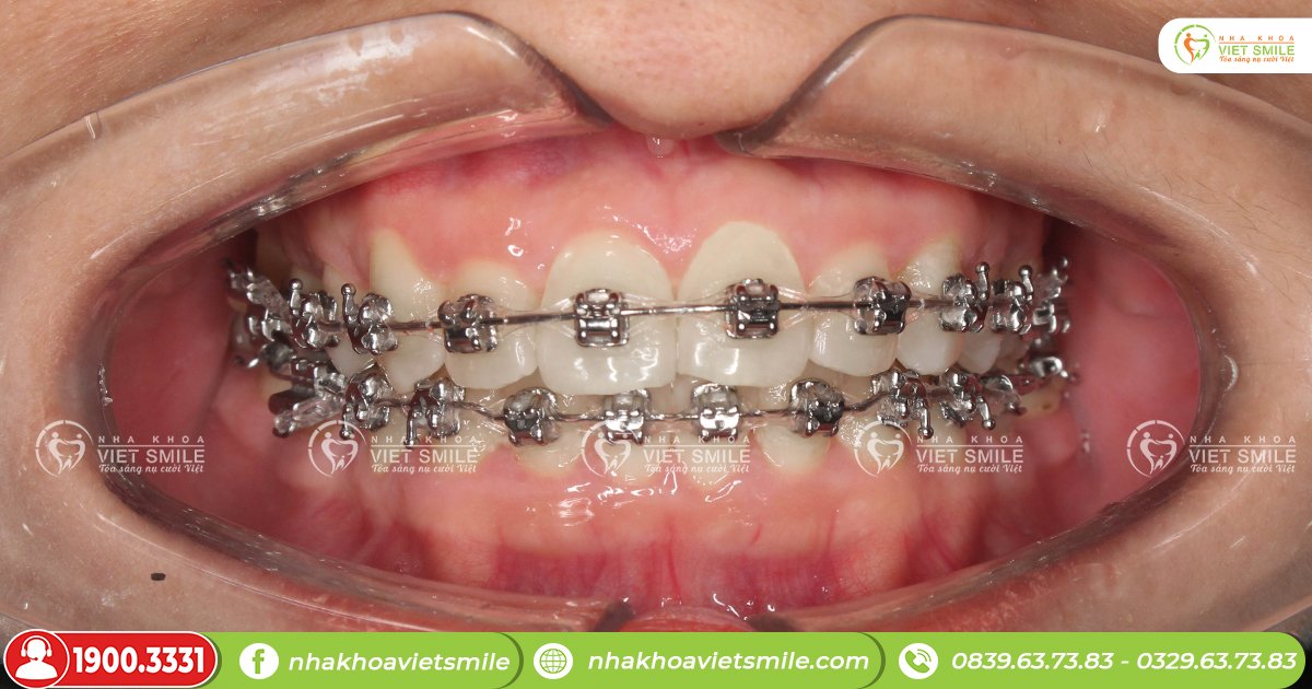 Quá trình niềng răng kéo dài từ 12-24 tháng