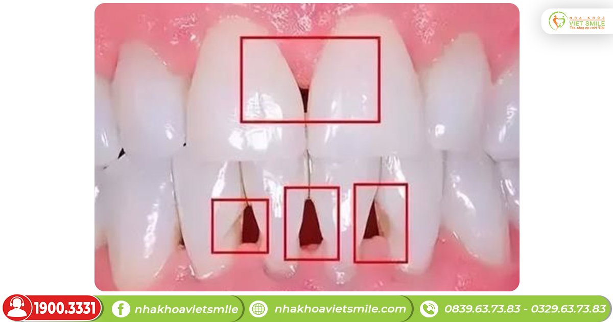 Tam giác đen ở răng (tam giác nướu) là gì?