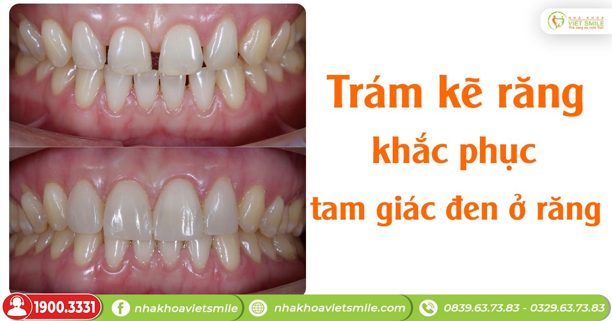 Trám kẽ răng khắc phục tam giác đen ở răng