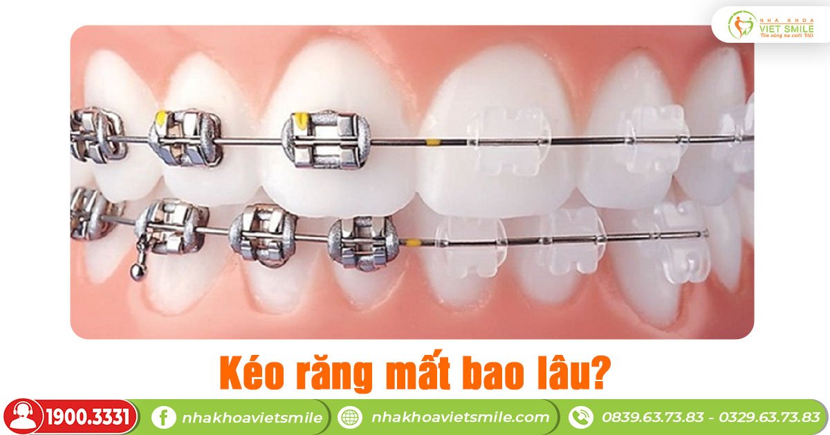 Kéo răng mất bao lâu?