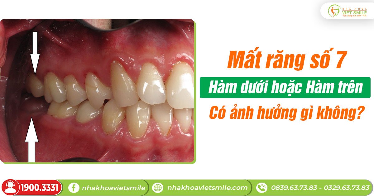 Mất răng số 7 hàm dưới hoặc hàm trên có ảnh hưởng gì không?