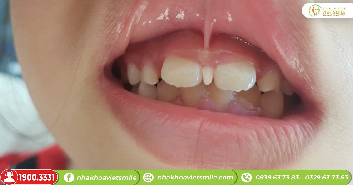 Răng thừa mọc giữa 2 răng cửa ở trẻ em