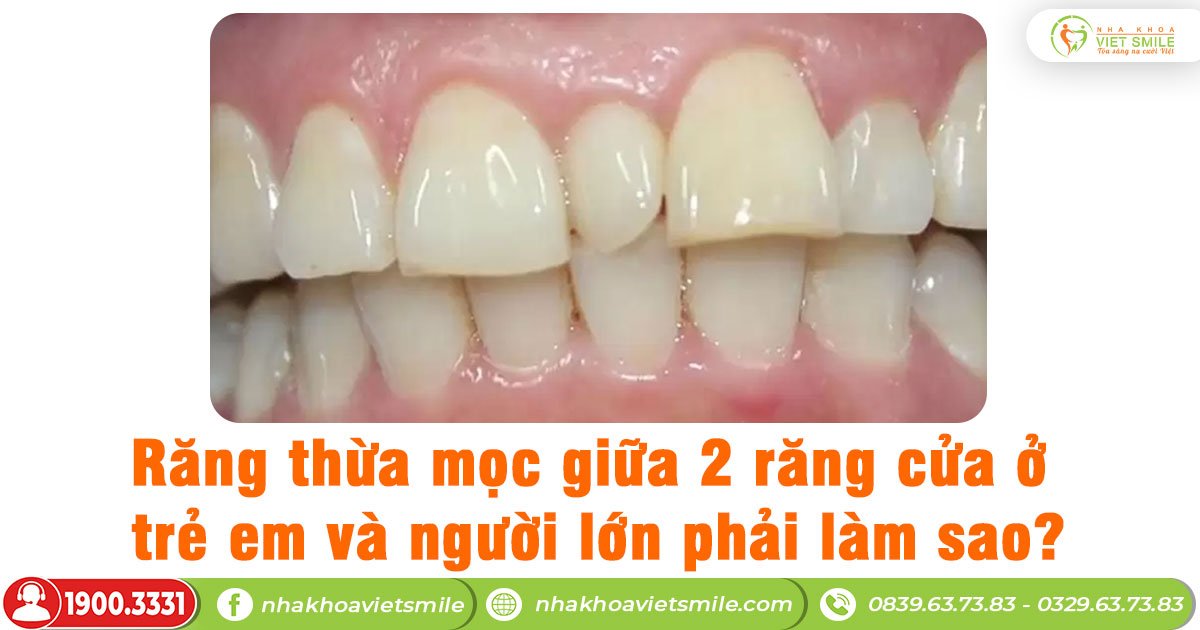 Răng thừa mọc giữa 2 răng cửa ở trẻ em và người lớn phải làm sao?