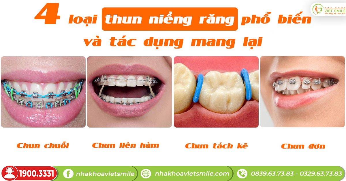 4 loại thun niềng răng phổ biến và tác dụng mang lại