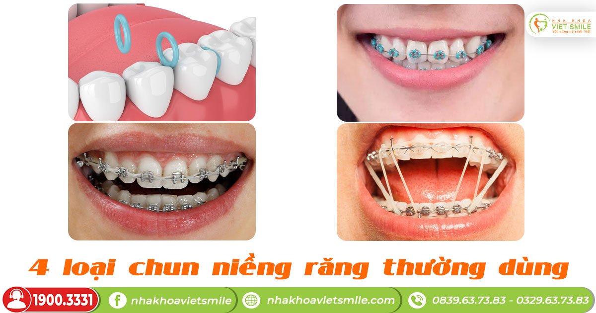 4 loại thun niềng răng thường dùng