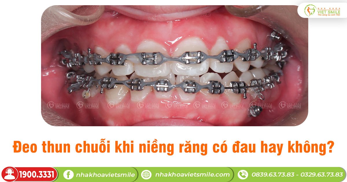 Đeo thun chuỗi khi niềng răng có đau hay không?