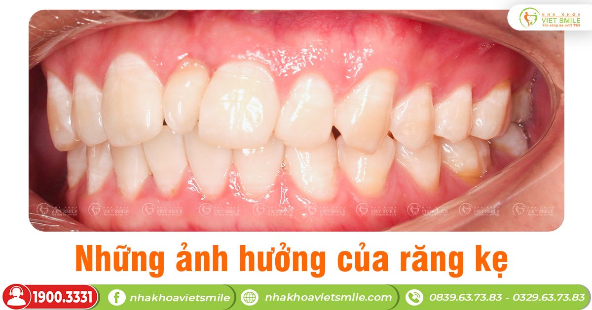 Những ảnh hưởng của răng kẹ