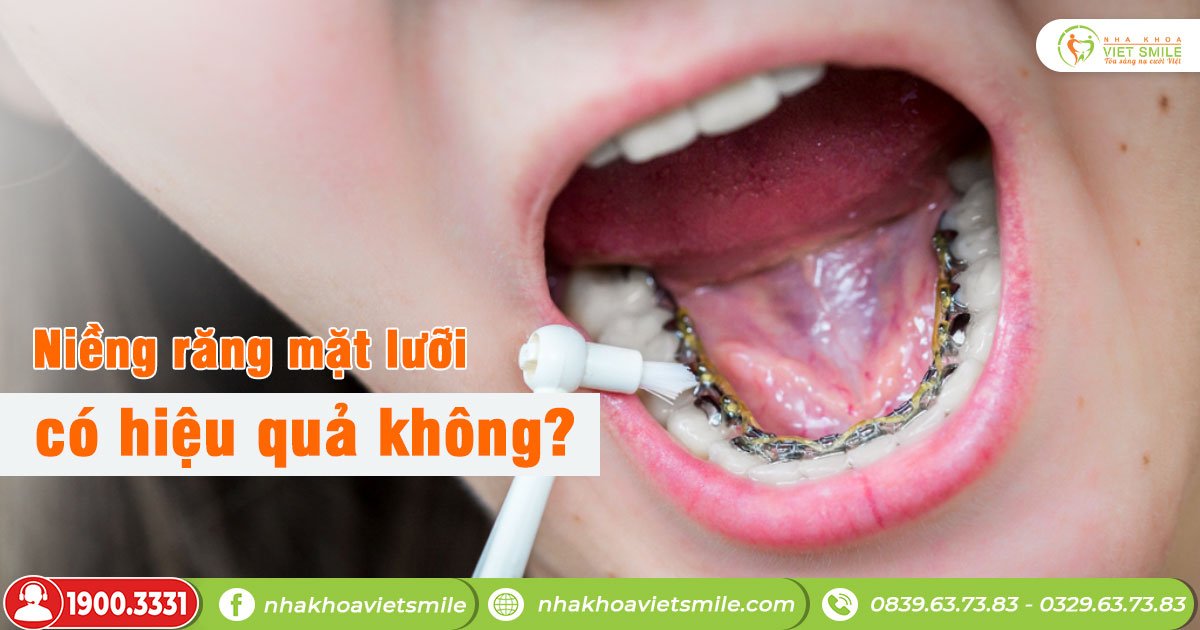 Niềng răng mặt lưỡi có hiệu quả không?