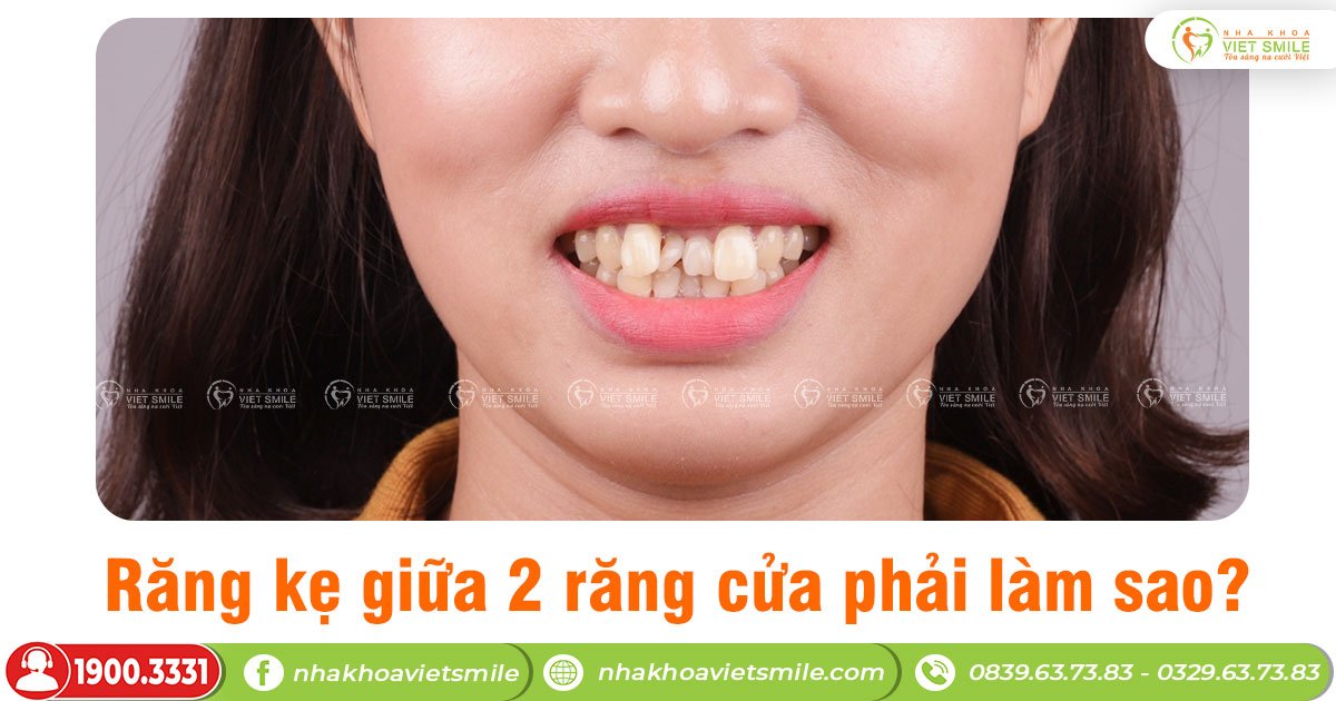 Răng kẹ giữa 2 răng cửa phải làm sao?