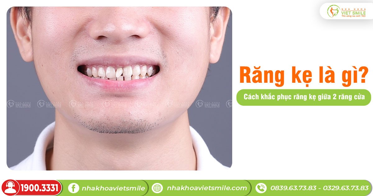 Răng kẹ là gì? Cách khắc phục răng kẹ giữa 2 răng cửa